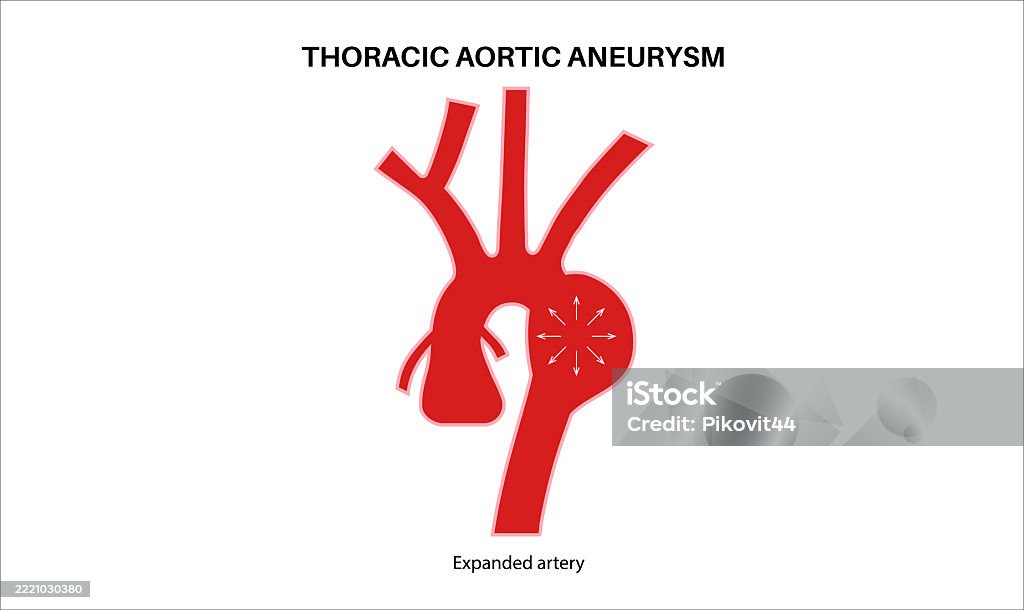 Thoracic Aortic Aneurysm Stock Illustration - Download Image Now ...