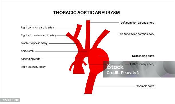 Thoracic Aortic Aneurysm Stock Illustration - Download Image Now ...