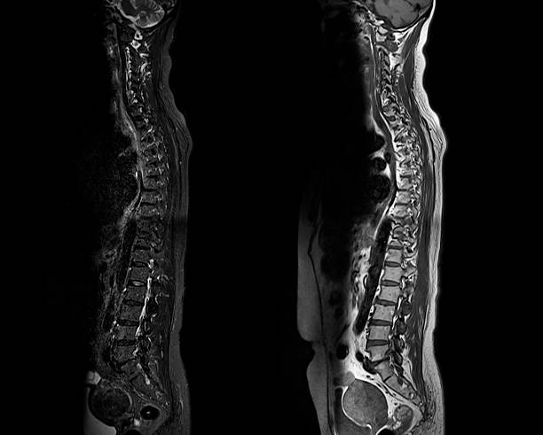 istock MRI whole spine screening for diagnosis spinal cord compression. 2221481425
