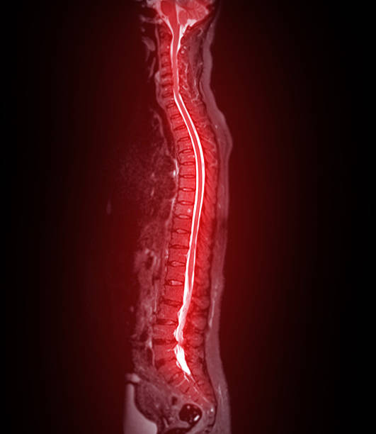 istock MRI whole spine screening for diagnosis spinal cord compression. 2221481629