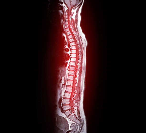 istock MRI whole spine screening for diagnosis spinal cord compression. 2221481701