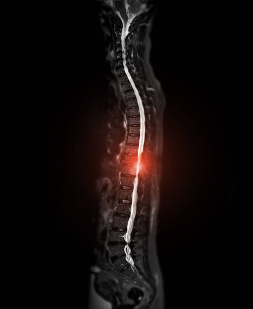 istock MRI whole spine screening for diagnosis spinal cord compression. 2221481811
