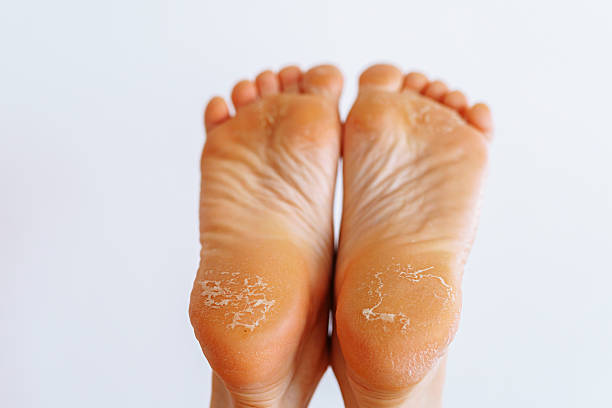 istock cracked peeling skin on woman's feet 2221701999