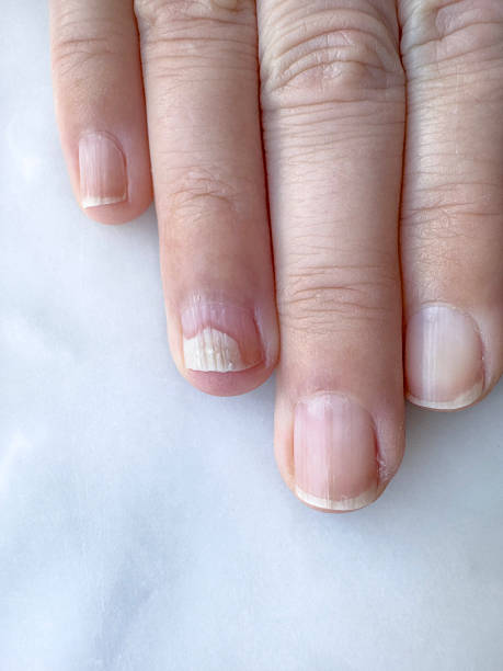 istock Damaged Fingernail with Peeling Layers and White Lines 2221822718