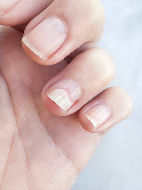 istock Damaged Fingernail with Peeling Layers and White Lines 2221825662
