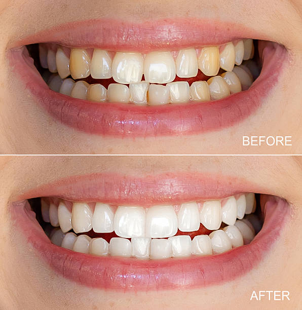 istock Comparison of teeth before and after a whitening treatment for brighter smiles 2221966449