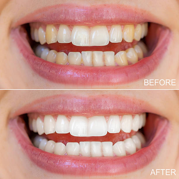 istock Before and after results of teeth whitening and alignment correction 2221966459
