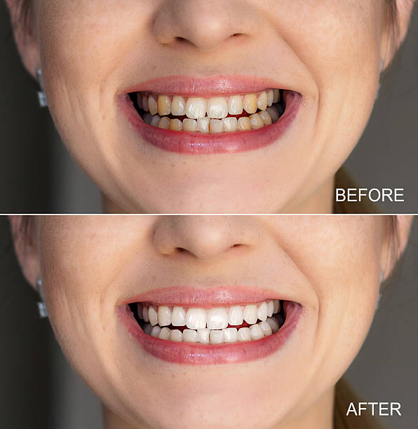 istock Comparison of teeth whitening results shown in before and after perspective 2221966474