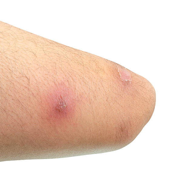 istock abscess or skin disease on human thigh isolated on white background with clipping path 2221994917