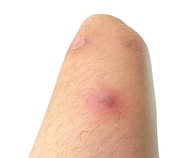 istock abscess or skin disease on human thigh isolated on white background with clipping path 2221995016