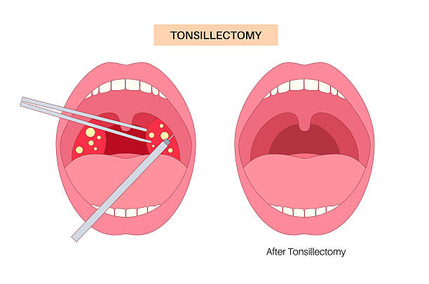 tonsillectomy procedure poster - mandle lidská ústa stock ilustrace