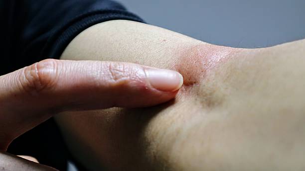 istock Person pointing at mosquito bites on arm 2222520062