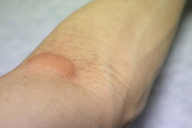 Close-up photo of a mosquito bite on an arm