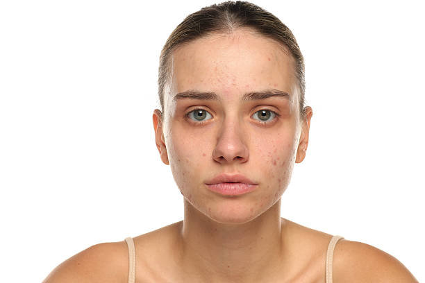 A woman with visible acne on her face A woman with visible acne on her face