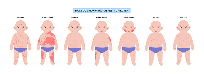 Antiviral Rash The Most Common Viral Rashes Stock Illustration - Download Image Now ...