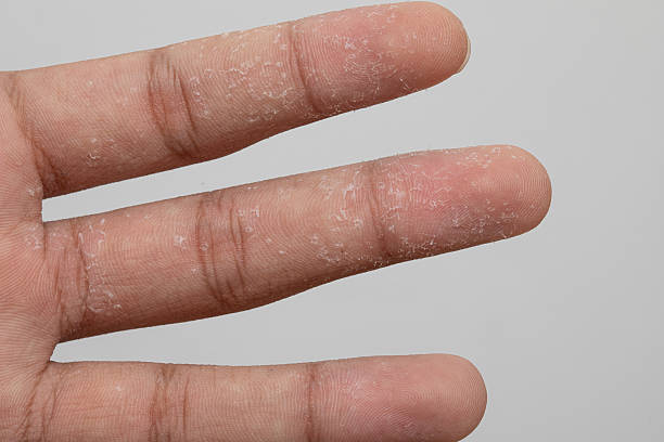 istock Exfoliative keratolysis causing peeling skin on fingers 2223073427