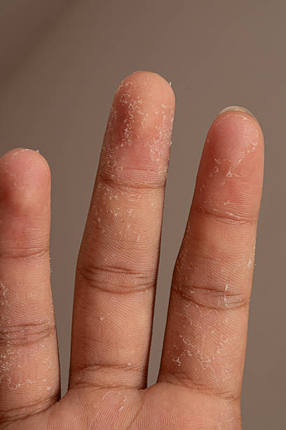 istock Dry skin showing peeling on fingers suffering from eczema 2223073439
