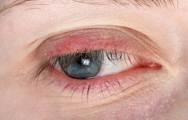istock Inflammation on the eyelid, stye on the eye 2223079284