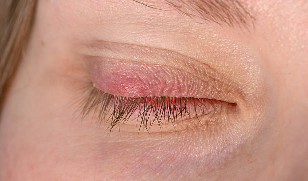 istock Stye on the eye, upper eyelid with a red ball 2223079286