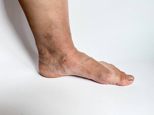 First signs of vein disorder as subtle swelling and visible surface veins, indicating early-stage venous insufficiency in adult lower limb. signs venous reflux or chronic venous insufficiency. stock photo