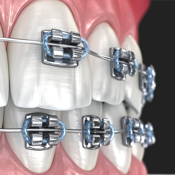 istock Metal braces on teeth, macro view. 3D illustration 2223220616