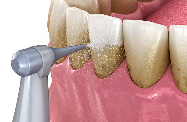 istock Oral hygiene: Air flow teeth cleaning process. Dental 3D illustration 2223220625