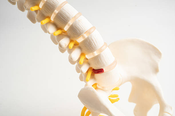 istock Lumbar spine displaced herniated disc fragment, spinal nerve and bone. Model for treatment medical in the orthopedic department. 2223225149