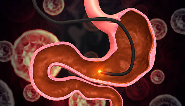 istock Stomach cancer, stomach Endoscopy. 3d illustration 2223338928