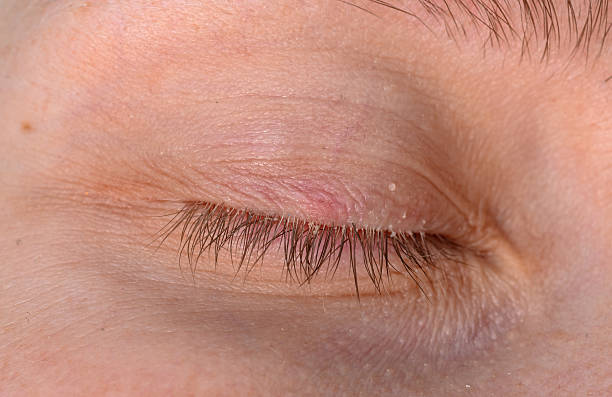 istock Glued eyelashes close up, demodex disease, closed eye 2223370986