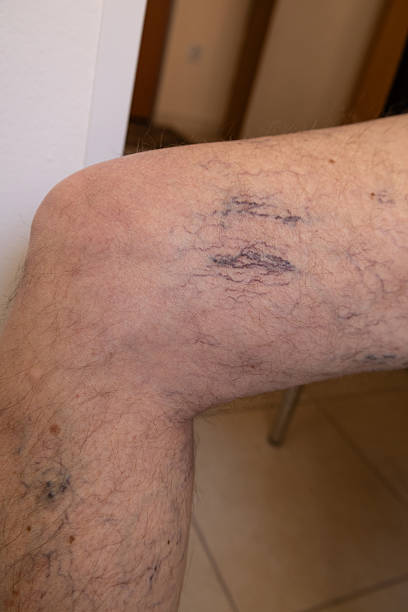 istock Close-up of varicose veins on elderly leg 2223895717