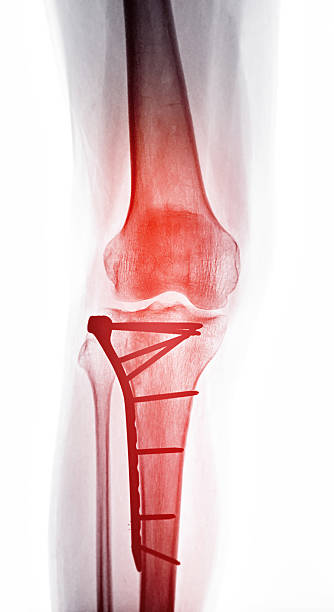 istock A diagnostic X-ray showing a post-surgery knee fracture, with the bone held together by a plate and screws, illustrating the surgical intervention for healing. 2224079243