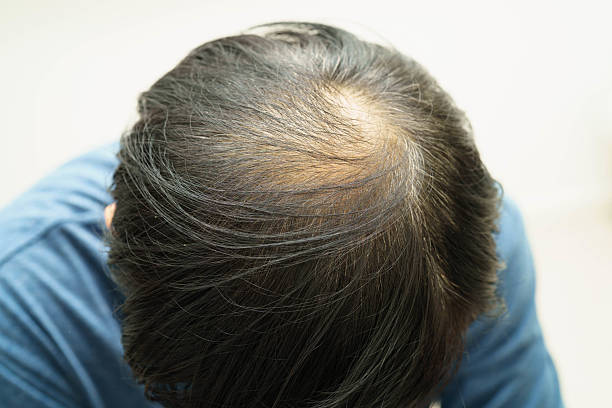istock Bald head in man, hair loss treatment health problem. 2224571614