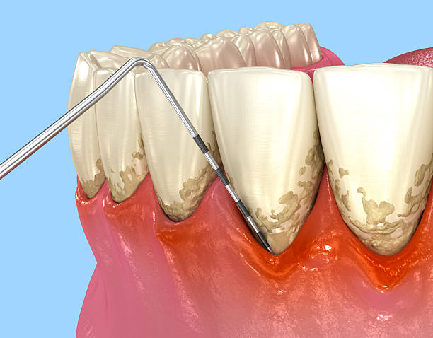istock Gum recession test. Dental3D illustration 2224860215