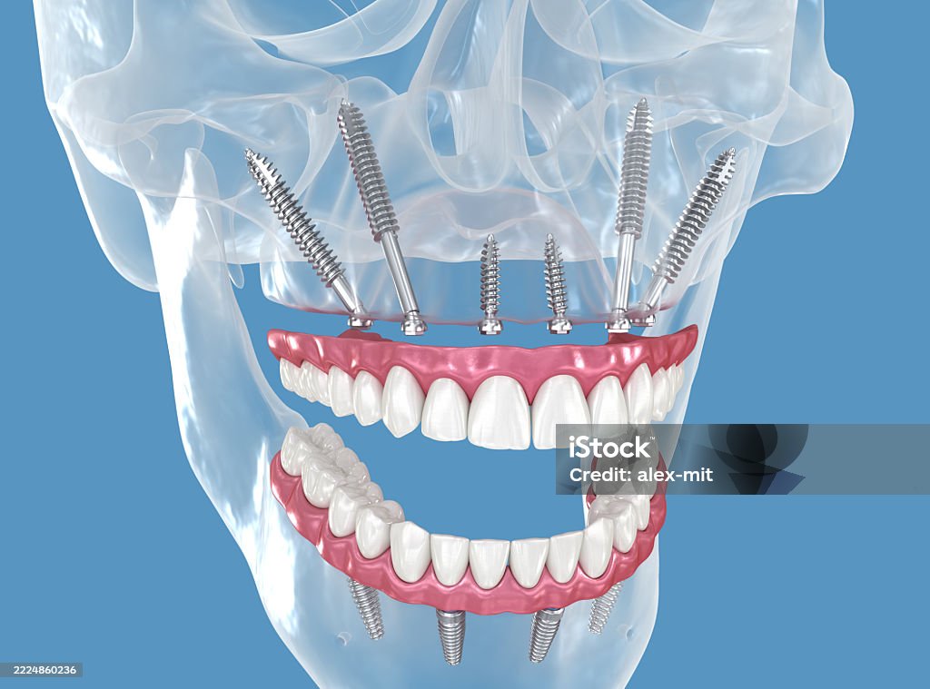 Maxillary Prosthesis Maxillary Prosthesis Supported By Zygomatic Implants 3d Illustration ...