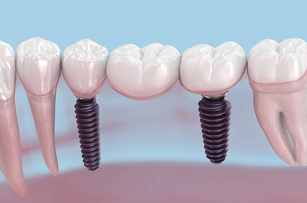 istock Dental bridge based on two implants. Medically accurate 3D illustration of human teeth and dentures concept 2224864207