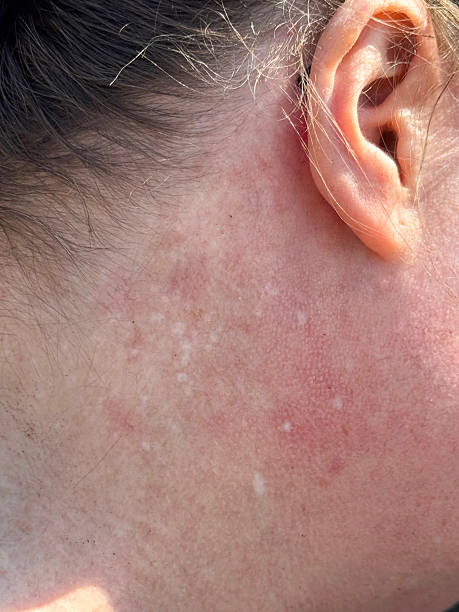 istock Image of woman experiencing menopause, natural skin changes, patchy marks on neck, ageing, hormonal effects on skin 2224910203