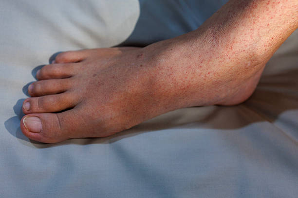 the soles of a toddler's feet are blistered.  isolated white background