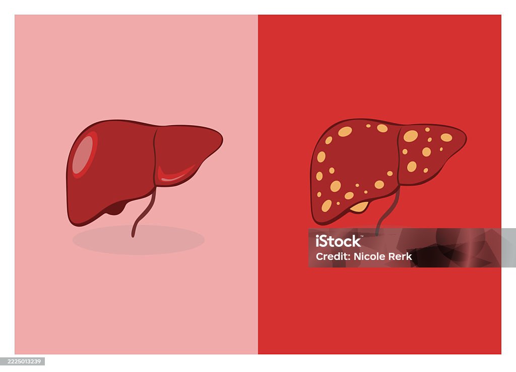 Normal Liver Element A Part Of Organs Normal Liver Vs Fatty Liver Stock Illustration ...