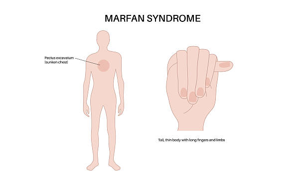Marfan syndrome poster Marfan syndrome finger length test. Arachnodactyly and pectus excavatum. Steinberg sign concept, thumb protrusion from a clenched fist. Anatomical drawings of hand and fingers vector illustration dna backbone stock illustrations
