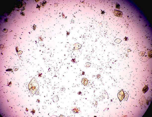 istock Urine Test Microscopic urinalysis, Uric Acid, Calcium oxalate. 2225169602