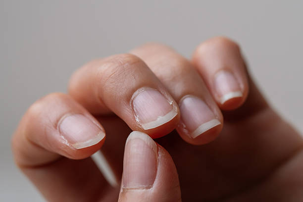 istock Finger with dry skin around the nails. 2225223301