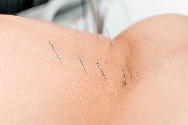 istock Acupuncture needles inserted into patient back during medical therapy. Traditional pain relief method. Spine healing. Orthopedic treatment. Manual procedure body recovery, physical rehabilitation. 2225225191