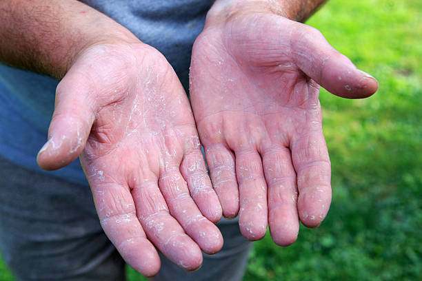 istock Hand eczema with dry, cracked hands 2225369595
