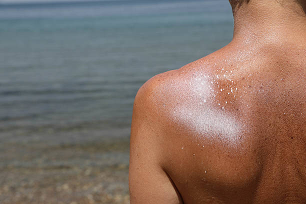 istock Shoulder with Visible Sunscreen Spray Residue by the Sea 2225530066