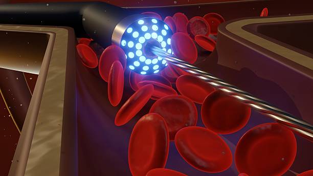 istock A laser atherectomy device operating within an artery 2225532277