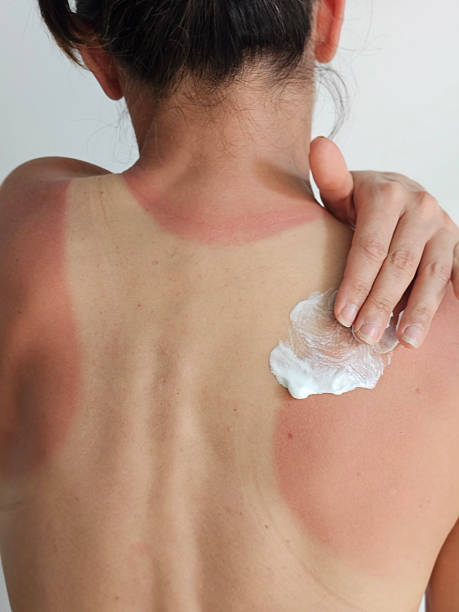 istock Sunburn relief application on back by individual with skin irritation from sun exposure concept 2225609880
