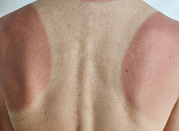 istock Sunburned back with red patches indicating overexposure during outdoor activity concept 2225609883