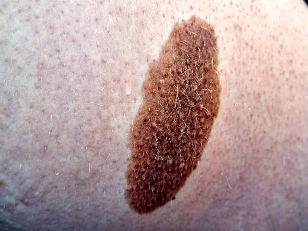 istock Large Brown Mole on Human Skin Close-Up 2225997091
