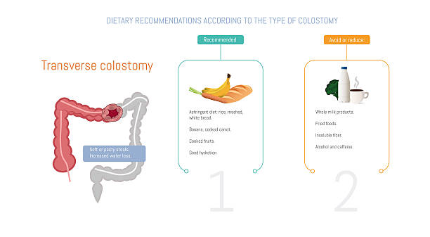 Colostomy Guidelines 80+ Colostomy Stock Illustrations, Royalty-Free Vector Graphics & Clip ...