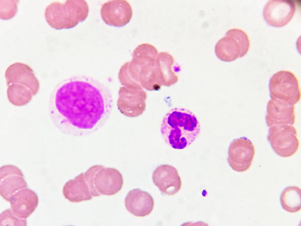 istock leucoerythroblastic anemia. Marked rouleaux formation. Microscopic examination. 2226384445